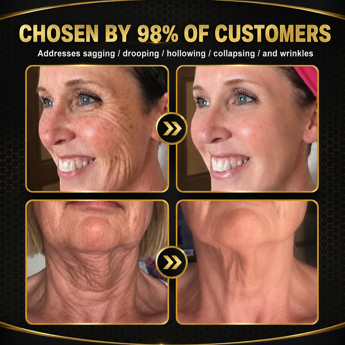 🐝Official Brand Black & Gold Upgraded Edition丨Rolimey® Bee venom Pro Comprehensive Cream —Tightening for Skin Types